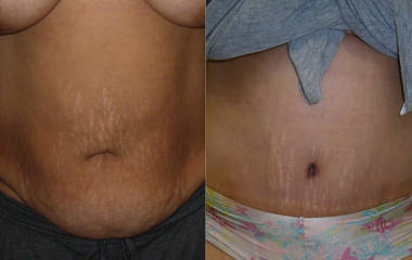 Abdominoplasty before and after showing flatter abdomen and tightening of the lower belly