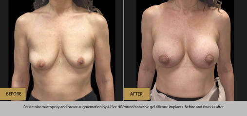 Before and after periareolar mastopexy with 425cc high profile silicone implants showing fuller and lifted breast shape