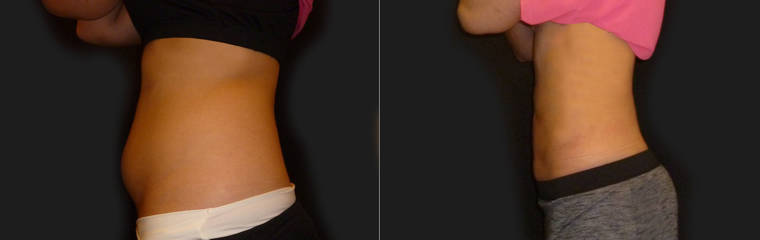 Before and after abdominal liposuction showing slimmer waistline and enhanced body contour