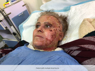 Reconstructive care for patient with severe facial burns
