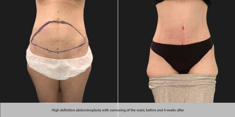 Before and 4 weeks after high definition abdominoplasty with narrowing of the waist