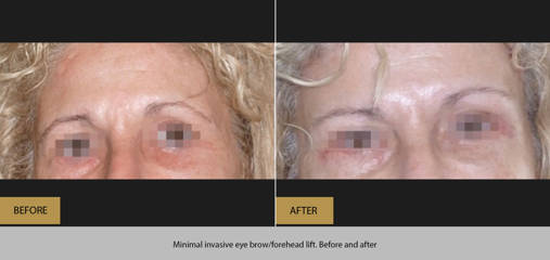 Before and after eyebrow lift showing higher brow position and smoother forehead