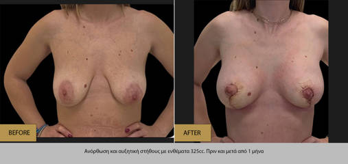 Before and after breast lift augmentation using 325cc silicone implants, showing reshaped and elevated contour
