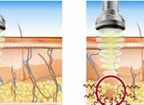 Illustration showing ultrasound waves penetrating skin layers to target fat and stimulate collagen regeneration
