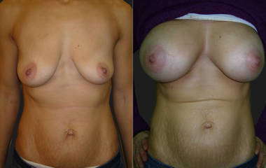 Before and after breast augmentation showing enhanced volume and refined breast contour