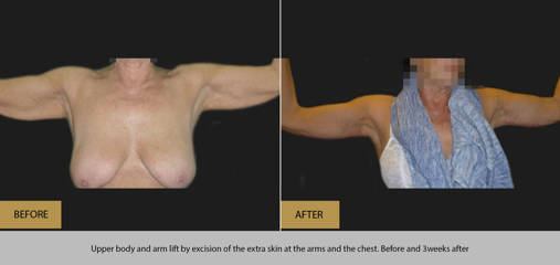 Upper body and arm lift by excision of extra skin at the arms and the chest, before and 3 weeks after