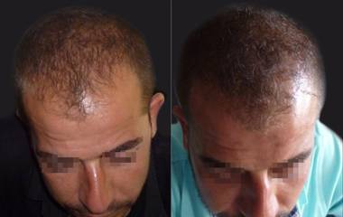 Before and after hair transplantation on male patient showing reduced frontal hair thinning and gradual hair density increase
