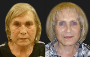 Before and after full facelift showing refined jawline and smoother neck contour