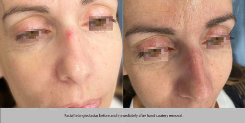 Before and after facial telangiectasias cautery removal
