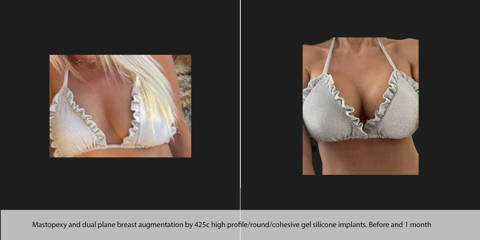 Before and after breast lift and augmentation with 425cc high profile silicone implants in dual plane