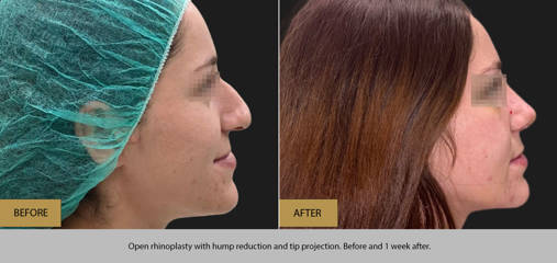 Before and after open rhinoplasty with dorsal hump reduction and tip projection