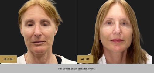 Before and 3 weeks after full face lift
