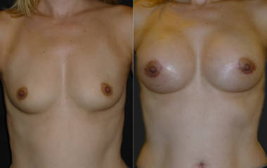 Before and after breast augmentation with silicone implants showing enhanced volume and natural contour
