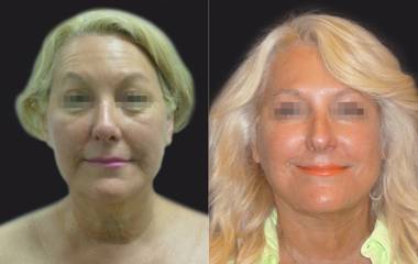 Before and after facelift showing enhanced jawline, smoother neck contour, and refreshed lower-face appearance
