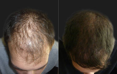 Before and after hair transplantation showing improved hair density and restored frontal hairline