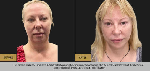 Before and 4 months after full facelift plus upper and lower blepharoplasty and high definition neck liposuction