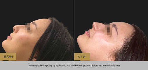 Side profile before and after non-surgical rhinoplasty with hyaluronic acid and Botox