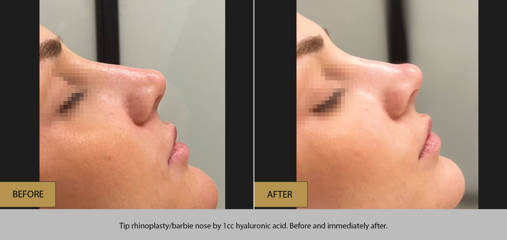 Side profile before and after tip rhinoplasty, Barbie nose, with 1cc hyaluronic acid