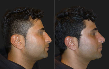Side view before and after rhinoplasty in male patient correction nasal hump and refining nose shape