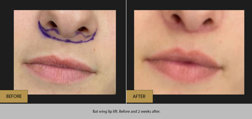 Before and after lip filler enhancement showing fuller lips and refined border