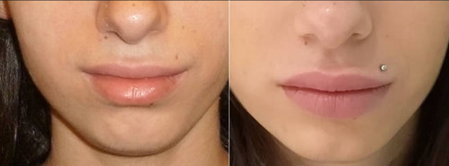 Before and after facial implant surgery showing improved facial contours and enhanced bone definition