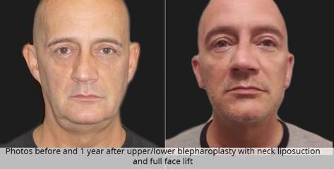 Before and one year after upper and lower blepharoplasty with neck liposuction and full facelift