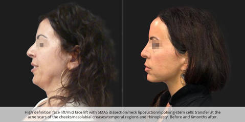 Side view before and six months after high definition face lift with SMAS dissection and neck liposuction