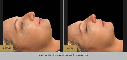 Non-surgical rhinoplasty result on woman 
