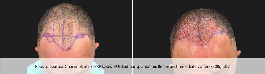 Before and after robotic assisted hair transplantation, with choi implanters
