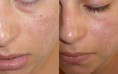 Before and after laser treatment of spider veins on the cheek area showing reduced redness and clearer skin