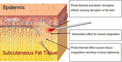 Λιπόλυση με Laser