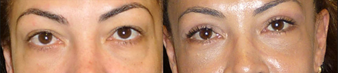 Lower before and after blepharoplasty showing reduced under-eye puffiness and smoother lower eyelid contour