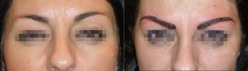 Before and after eyebrow micropigmentation showing refined brow shape, fuller appearance and enhanced definition