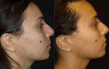 Before and after showing significant reduction of acne and clearer skin on a woman's face
