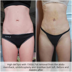 Before and after high-definition liposuction and umbilicoplasty showing toned abdomen and refined contour