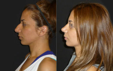 Side view before and after rhinoplasty showing correction of nasal hump and improved nose profile in female patient
