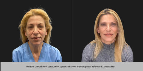 Before and 3 weeks after full face lift with neck liposuction, and upper and lower blepharoplasty
