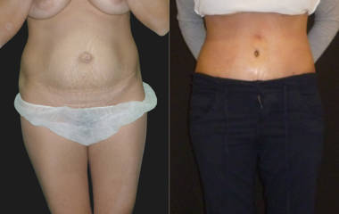 Before and after abdominoplasty with removal of excess abdominal skin and muscle tightening