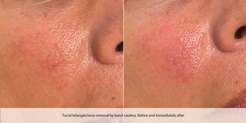 Before and after spider vein laser removal on facial skin showing reduced redness and clearer complexion 