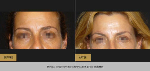 Before and after minimal invasive eye brow and forehead lift