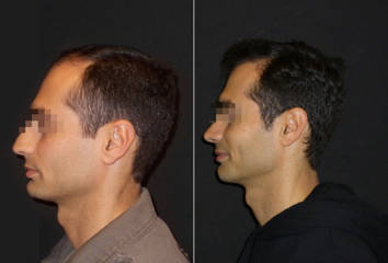 Side view before and after male rhinoplasty showing correction of dorsal hump and slightly elevated nasal tip