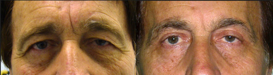 Upper blepharoplasty before and after, showing improved eyelid contour and reduction of excess skin