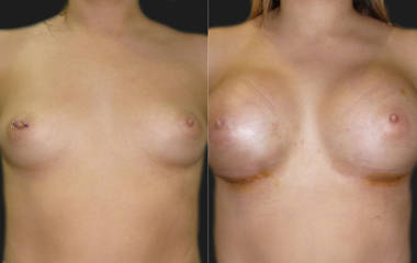 Before and after breast augmentation with silicone implants showing contour and enhancement