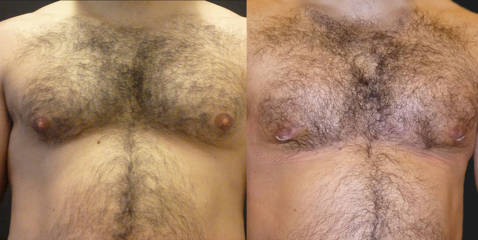 Before and after gynecomastia correction showing flatter chest contour and reduced gland fullness