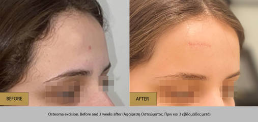 Before and three weeks after forehead osteoma removal, with surgical site healing well