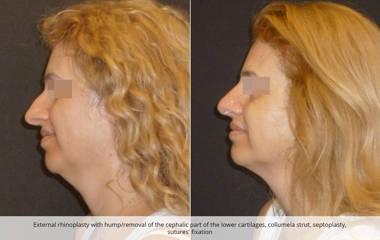 Side profile of woman before and after rhinoplasty and septoplasty with hump removal and cartilage refinement