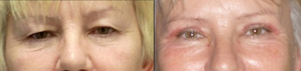 Before and after upper and lower blepharoplasty showing lifted eyelids and smoother under-eye area