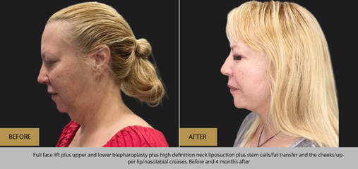 Side view before and 4 months after full face lift, upper and lower blepharoplasty and high definition neck liposuction