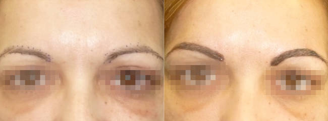 Before and after of eyebrow micropigmentation showing newly enhanced brow arch and pigment detail
