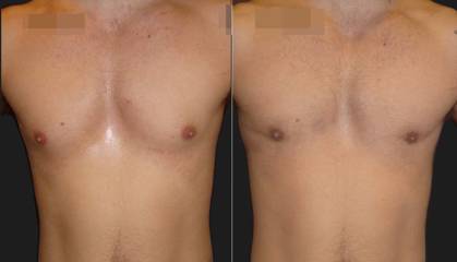 Before and after gynecomastia correction showing improved symmetry and flat male chest contour